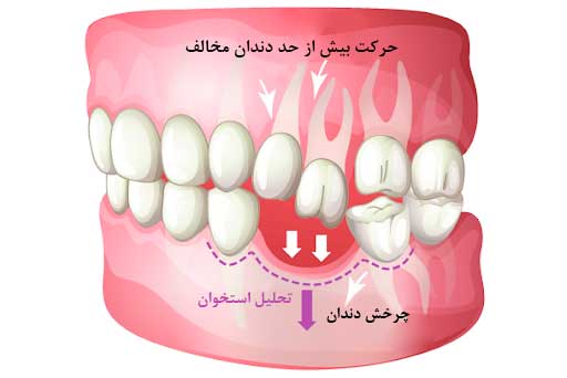 حرکت دندان-کلینیک دندات پزشکی مدرن