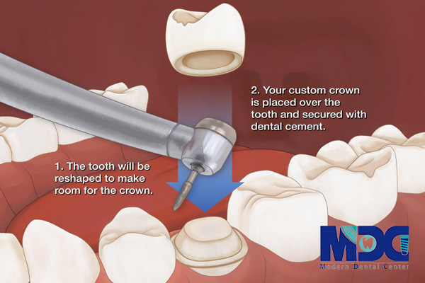 معایب روکش دندانی - کلینیک دندانپزشکی مدرن
