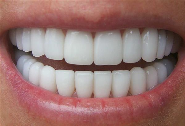 طول عمر لمینت دندان