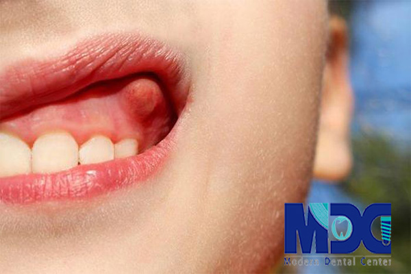 درد لثه -کلینیک دندانپزشکی مدرن