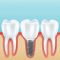 ایمپلنت یا کاشت دندان چیست؟
