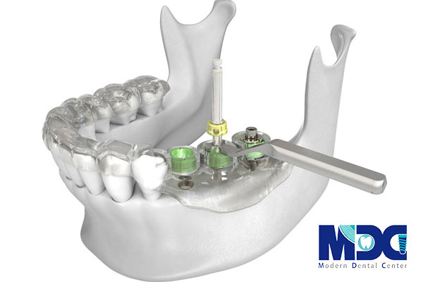 کاشت ایمپلنت با نویگیشن-کلینیک دندان پزشکی مدرن
