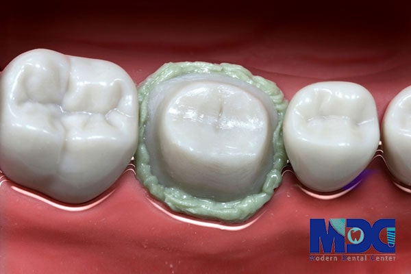 استفاده نخ زیر لثه در قالب گیری-کلینیک دندان پزشکی مدرن