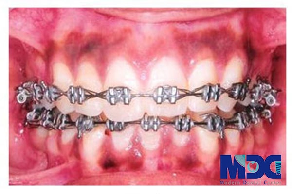 ارتودنسی ثابت-کلینیک دندان پزشکی مدرن