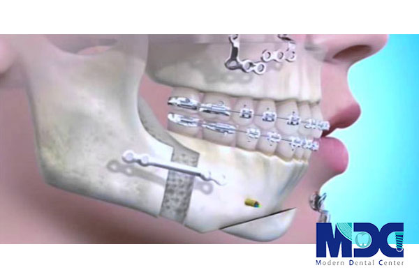 استخوان فک -کلینیک دندان پزشکی مدرن