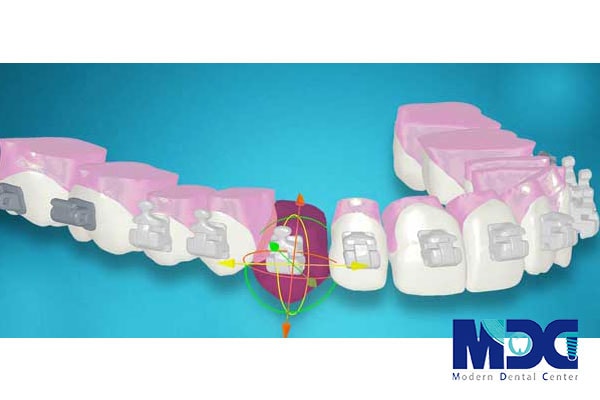 ارتودنسی با قالب سه بعدی-کلینیک دندان پزشکی مدرن