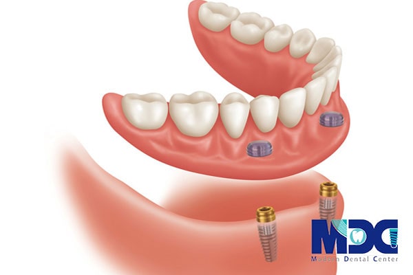 اوردنچر متکی بر ایمپلنت-کلینیک دندان پزشکی مدرن