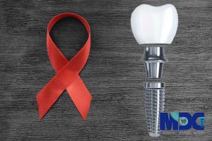 Read more about the article ایمپلنت بیماران مبتلا به ایدز