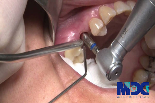 جراحی کاشت دندان-کلینیک دندان پزشکی مدرن