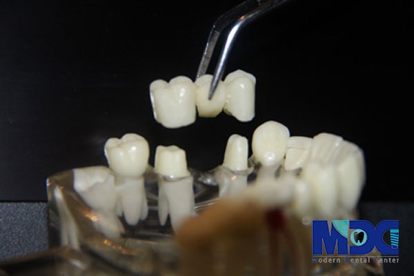 کاشت دندان-کلینیک دندان پزشکی مدرن