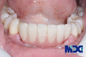 Read more about the article ایمپلنت فک پایین در بهترین کلینیک دندانپزشکی تهران