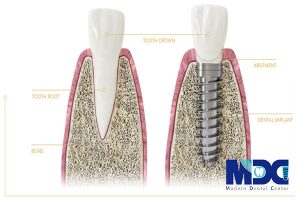 لقی ایمپلنت در مقایسه با دندان طبیعی