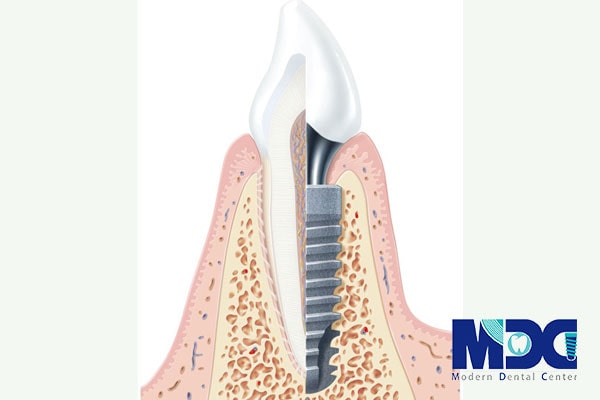 اصول جراحی کاشت ایمپلنت دندان