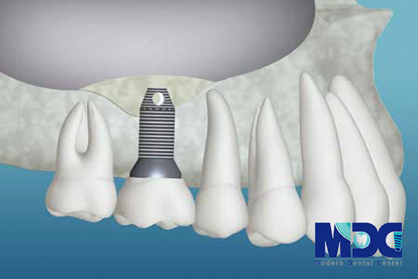 ورود ایمپلنت به حفره سینوس-کلینیک دندان پزشکی مدرن