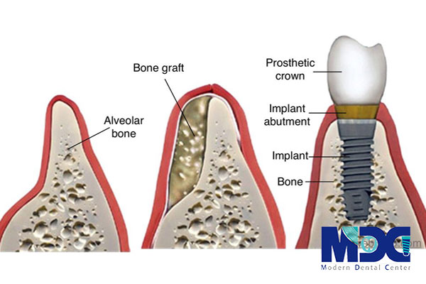 ویژگی‌های ایمپلنت دندان