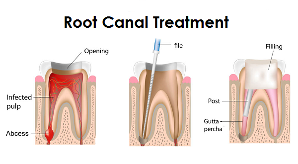 درمان ریشه-کلینیک دندانپزشکی مدرن
