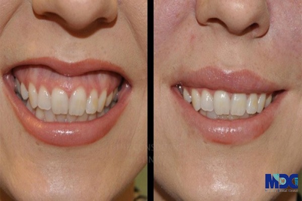 اصلاح لبخند لثه ای- کلینیک دندانپزشکی مدرن