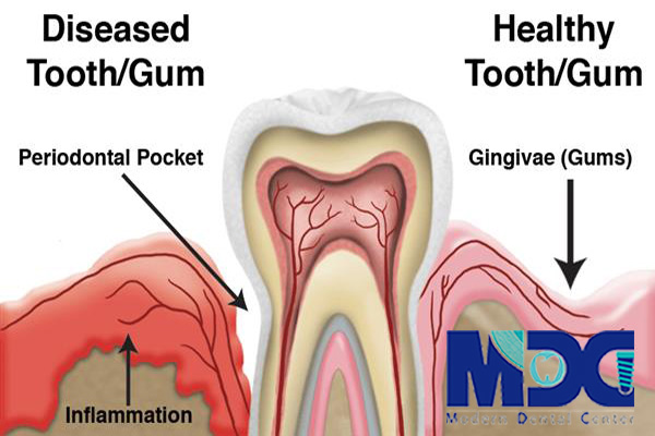 پاکت پریودنتال- کلینیک دندانپزشکی مدرن