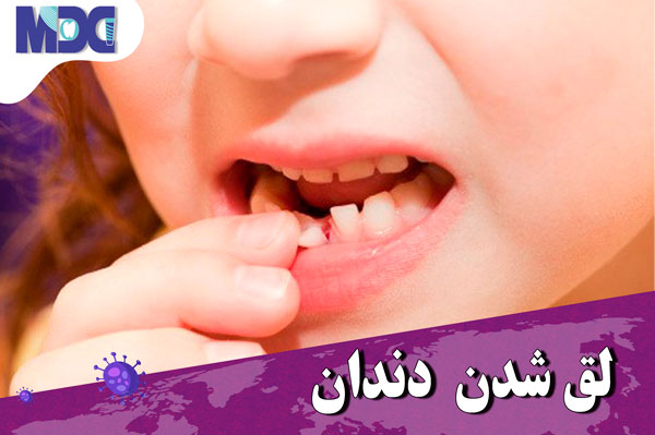 Read more about the article لقی دندان در زمان کرونا | آیا لقی دندان قابل درمان است ؟