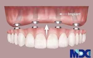 Read more about the article ایمپلنت کامل دندان ها-هزینه ایمپلنت کامل چقدر است؟