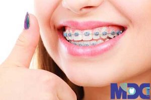 Read more about the article ارتودنسی فوری : راهی سریعتر برای صاف کردن دندان ها
