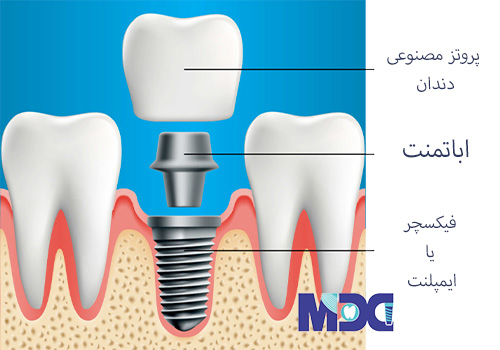 ایمپلنت دندان-کلینیک دندان پزشکی مدرن