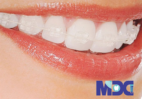 Read more about the article زیبایی دندان بدون ارتودنسی 6 روش این کار