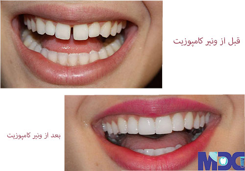 کامپوزیت دندان کج-کلینیک دندان پزشکی مدرن